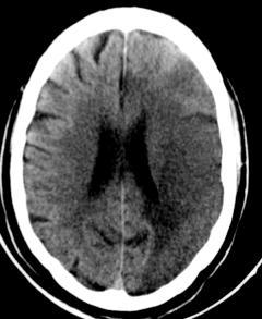 is not associated with edema or volume loss, so it has no effect on the adjacent ventricle Right temporal chronic