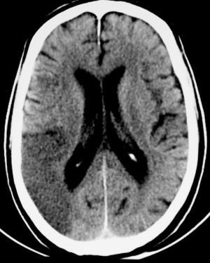 ----------------------------------------------------------------------------------------------------- Chronic infarction Loss of volume ( gliosis) negative mass effect on the ventricle and sulci