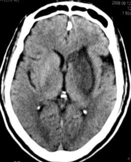 appear in the CT scan is 72 hours after vessel occlusion Male patient, 67 years old
