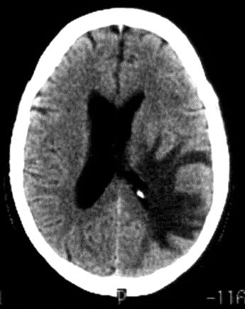 recent hematoma with intraventricular extension Bilateral