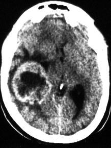 right cerebral hemisphere surrounded by vasogenic finger like brain edema hypodensity
