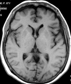 Sites of intracranial hemorrhage Epidural [2] Subdural [3] Subarachnoid [4] Intra-cerebral [5] Intra-ventricular [6] As a general rule Acute hematoma (
