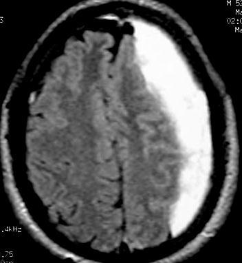 Extraaxial hemorrhage [epidural or subdural] Blood extending along the inner