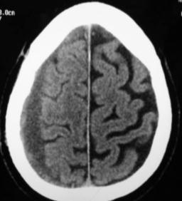 Subdural Hematoma Concave inner margin Can be acute, subacute or chronic Usually seen in elderly patient History of minor trauma