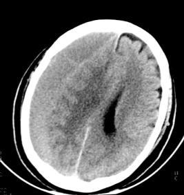 The left CT image shows the hyperdense acute hematoma on the left side.