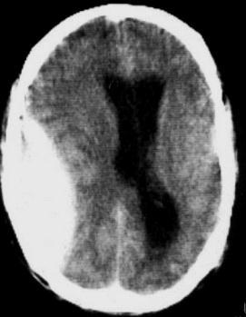 of the right lateral ventricle as well as both occipital horns Follow up of intracranial hematoma Epidural hematoma is almost always acute due to severe symptoms as it occurs in a tight space.