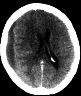 All types of subdural hematoma should have a mass effect which depends basically on the hematoma