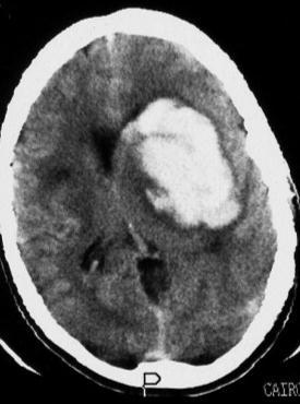 Haemorrhagic tumors Deposits 38% Gliomas 35% Meningiomas 14% Adenomas 9% Neuromas 2% NCCT of a recent left frontotemporal