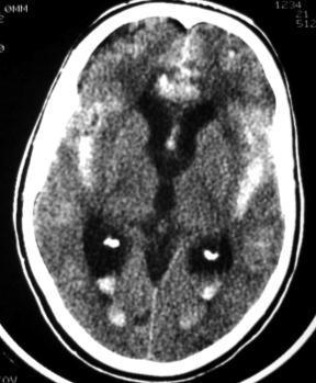 Intraventricular hemorrhage has to main causes Intracerebral hematoma extending into the ventricles Subarachnoid