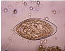 Eosinophilia with urinary symptoms Bilharzia Schistosoma haematobium Africa (great lakes, Malawi,