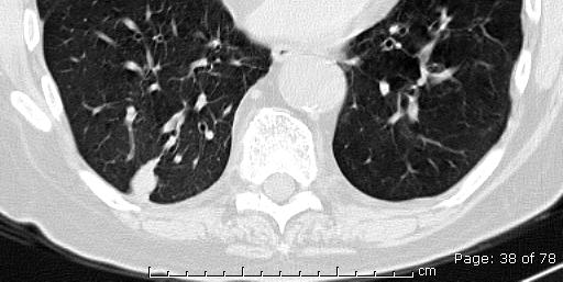 right lung (arrow).