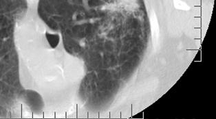 NSCLC Pre-procedure CT image Immediate post-procedure CT image