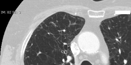 Sample Case Medically-inoperable NSCLC Diagnostic CT image