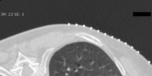 Post-RFA Imaging Follow-Up Any unexpected
