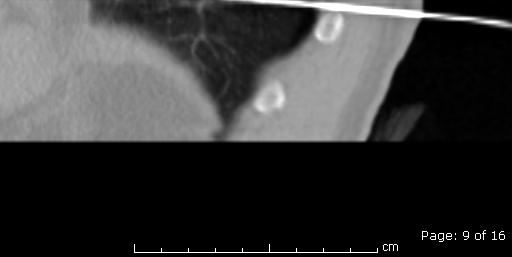 RFA Pre-procedure CT image.