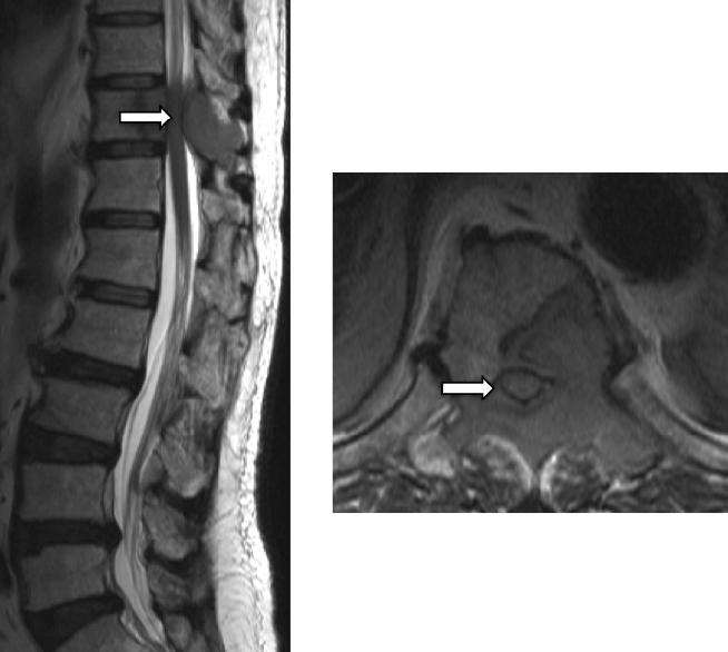 5.2 RISK FACTORS FOR PATHOLOGIC FRACTURE AND CORD COMPRESSION Pathological fracture was defined as cortical disruption, impaction of trabeculae and loss of vertebral body height, or vertebral