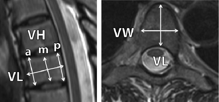 tumour occupancy (%TO) within the vertebral body, involvement of individual vertebral components (e.g.