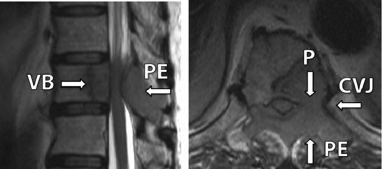 sagittal and axial cross section images from CT scan (above) and T2 weighted MRI (below).