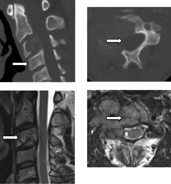Figure 5. Lytic Metastatic Lesion Typical appearance of lytic metastatic lesion on CT (above) and MRI (below). Note the bony definition on the CT and the soft tissue definition on the MRI. 5.2.