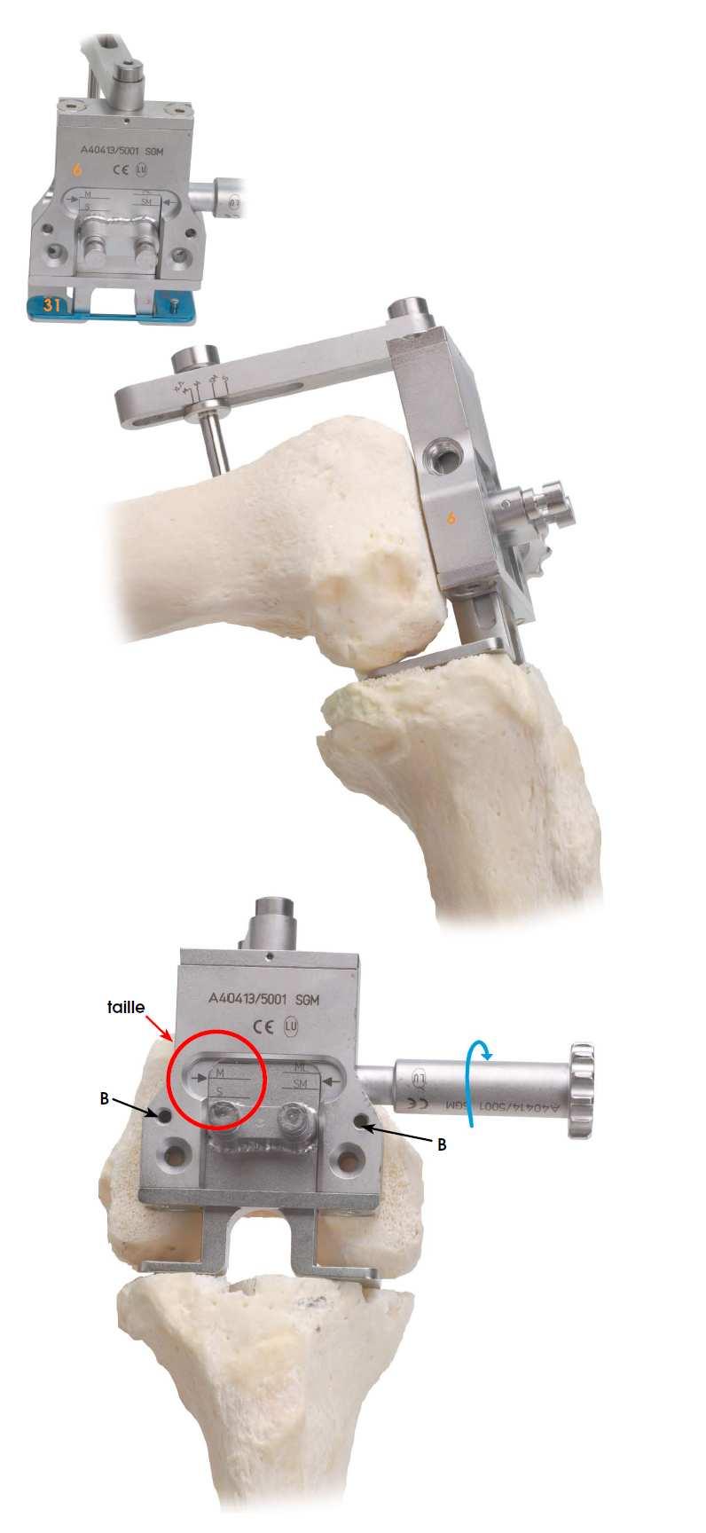 CHECKING Place the knee in extension. Check the stability in extension using the spacer (14) corresponding to the tibial resection: 9, 11, 13 or 16mm. FEMORAL ROTATION Place the knee at 90 flexion.