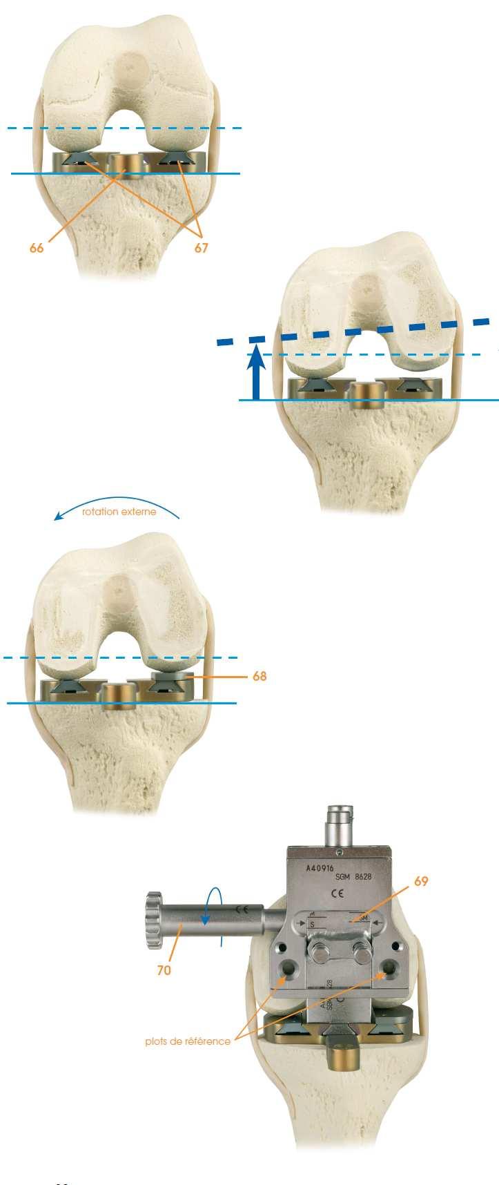 Possible determination of an external rotation of the femoral part via the rotation wedge (31) placed under the external condyle.