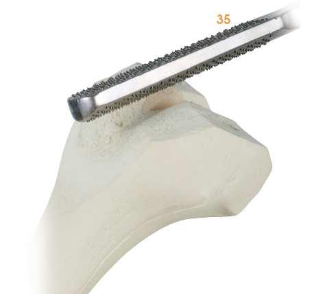 Perform the cuts: posterior cut (posterior chamfer) anterior cut (anterior chamfer) Extract the two