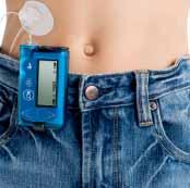 Where can my child keep his or her insulin pump? This is often one of the first questions asked by many parents and children. In fact, the pump can be easily attached to a belt or carried in a pocket.