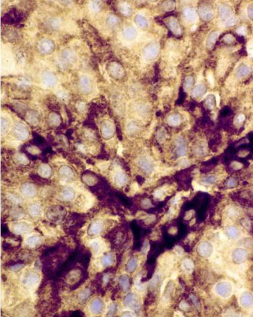 tumor present in the sella turcica. Fig. 4.