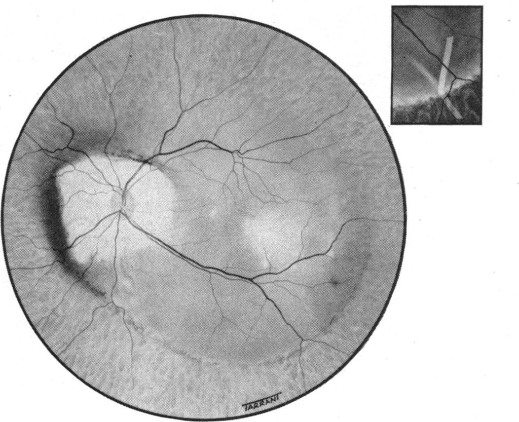 Brit. J. Ophthal. (1958) 42, 749. RETINAL DETACHMENT AT THE POSTERIOR POLE* BY CALBERT I.