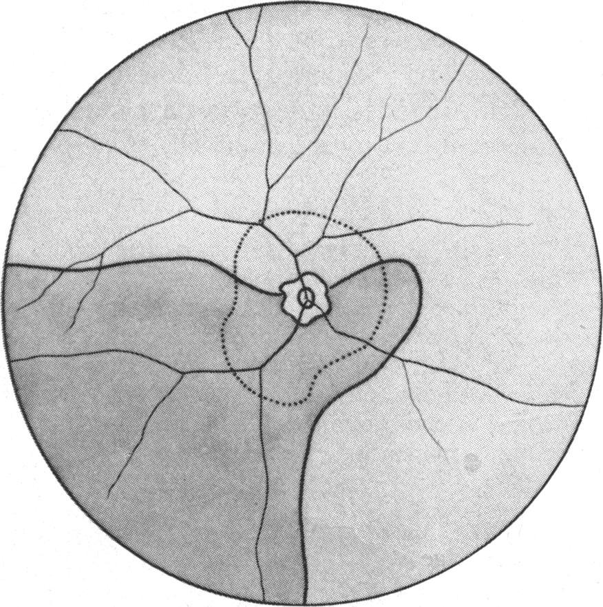 750 CALBERT I. PHILLIPS Case 2, a male, aged 38, had no knowledge of the time of onset of poor vision in the right eye. The visual acuity was 6/60 in the right eye with -17 D sph., -1 D cyl.