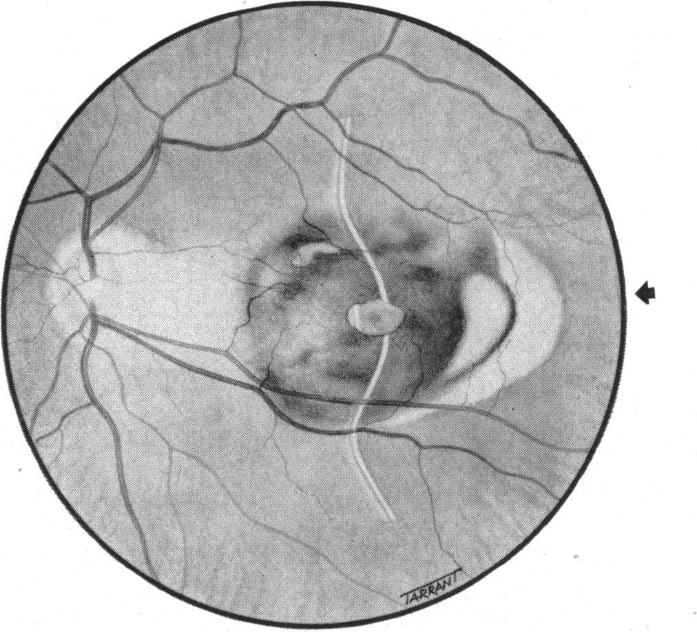 RETINAL DETACHMENT AT THE POSTERIOR POLE 751 FIG. 3.-Left fundus of Case 3, showing the macular region as seen with slit-lamp; in addition to a macular hole, there is another supero-nasally.
