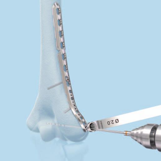 Insert Distal Screws in Lateral-Column Plate Optional: Variable angle Use the funnel-shaped end of the drill sleeve to drill variable angle holes at the desired angle.