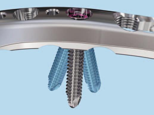 Variable angle locking Variable angle locking screws 2.7 mm give the surgeon the ability to create a fixed-angle construct with the freedom of +/-15 off-axis screw angulation.
