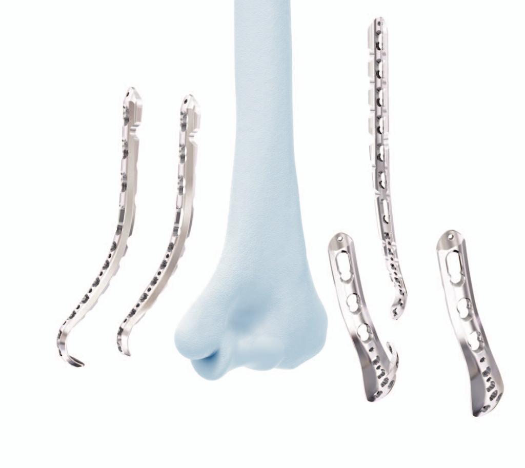 VA-LCP Distal Humerus Plates The plates offer multiple screw configurations for the medial and lateral columns, and the articular block. 3 2 1 5 4 1 Medial Plate The standard medial column plate.