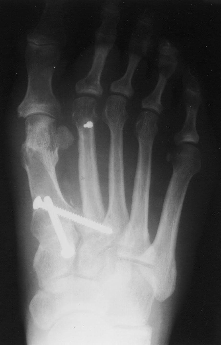 63 TABLE II Outcome Data* Baseline At 6 Mo At 12 Mo (N = 25) At 24 Mo (N = 18) Visual analog scale 6.2 ± 1.0 3.0 ± 1.7 1.5 ± 1.8 1.4 ± 1.3 AOFAS Hallux Metatarsophalangeal-Interphalangeal 47.6 ± 8.