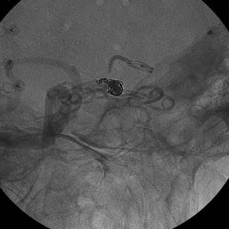 t 14 days after surgery, the patient s mental state worsened, and a CT revealed rebleeding from the aneurysm; catheter angiography demonstrated that the clips had slipped from the aneurysm (Fig. 4).