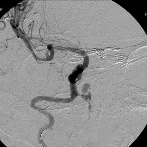 fter the repeated failure of surgical clipping, we performed endovascular trapping from the right distal 1 to the aneurysm (Fig. 4C).