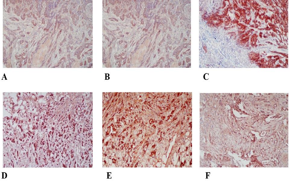888 Immunohistochemical markers in triple negative breast cancer Table 1.