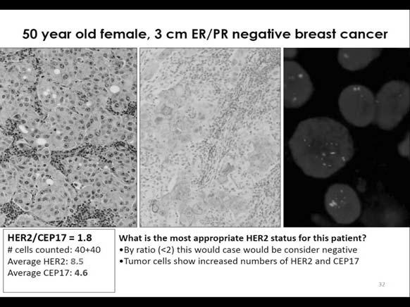 Heterogeneity Intratumoral heterogeneity for HER2 can be seen in breast cancer by IHC With heterogeneity, the fields selected for evaluation will