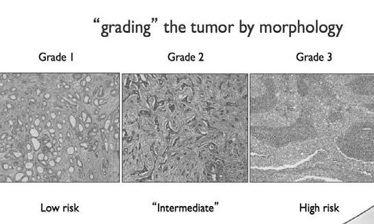 Tumor Size, Grade, Lymph Node Status, ER, PR, Her2 Tumor Boards-Good actor vs bad actor Breast cancer prognostic classification in the molecular era: the role of histological grade Histologic grade