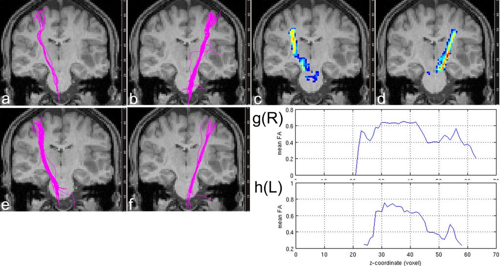 Figure 3.9 Patient #3 had a well defined tumor within the left temporal lobe. All tracking methods were successful.