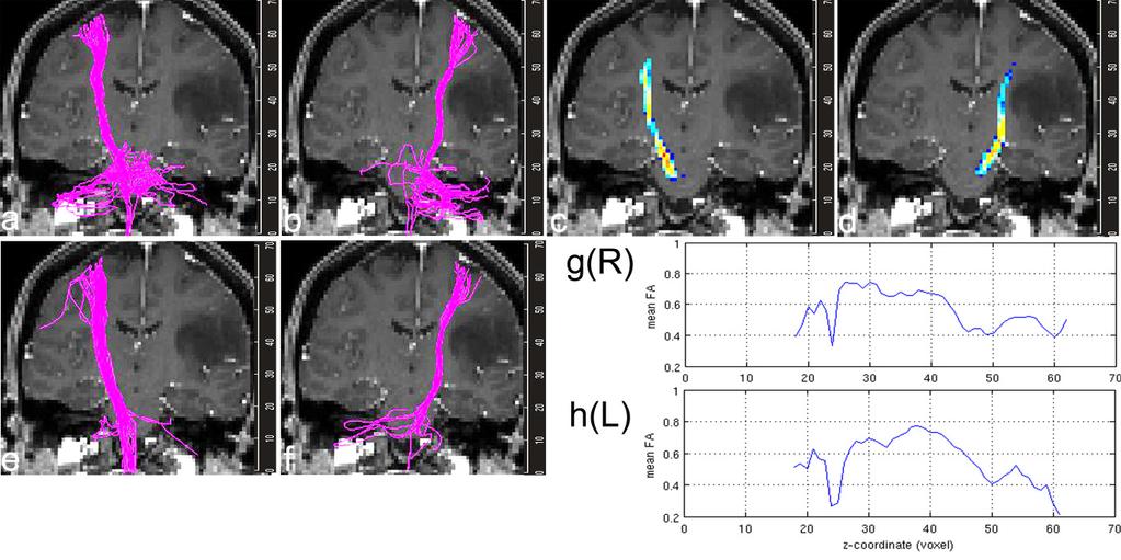 Figure 3.10 Patient #4 had a well defined tumor in the left frontal lobe. FMRI activations were found in the left M1 and left SMA during right hand movement.