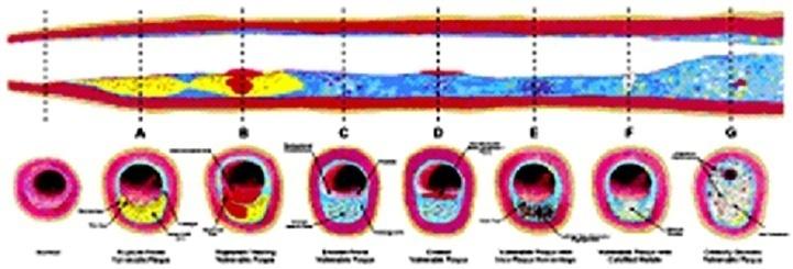 2 Mohammad Karimi Moridani Detection and Quantification of Coronary Atherosclerotic Plaque Using Different Imaging Modalities stratification and early treatment to prevent plaque rupture.