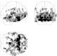 The images were spatially normalized by transferring them into a standardized space (Talairach and Tournoux, 1988) using a six parameter rigid body transformation.