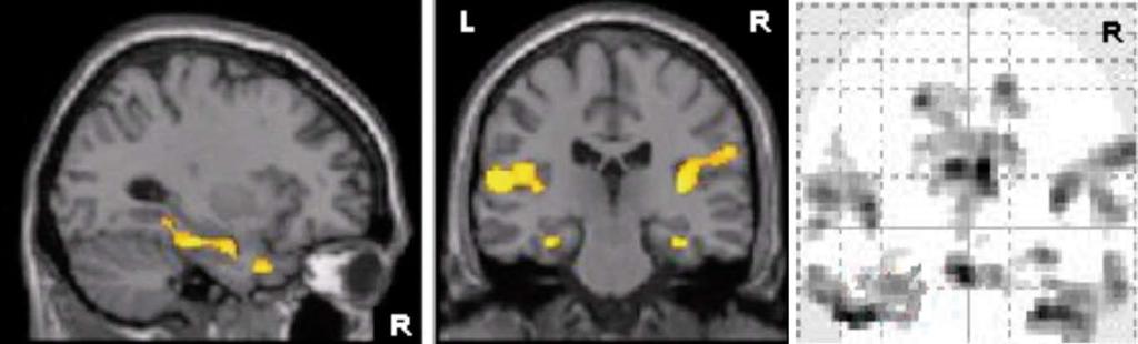 chapter 3 Figure 1 Whole brain activation pattern of 22 controls during (A) 0-back minus 2-back contrast and (B) 2-back minus 0-back contrast, thresholded at P=0.