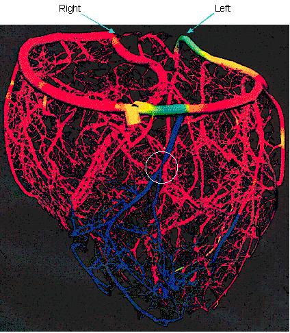 APPROACHES TO TREAT ANGINA PECTORIS Model of coronary circulation in angina pectoris Rapid flow is indicated by red and slow flow by blue Low flow blue area shows the effect