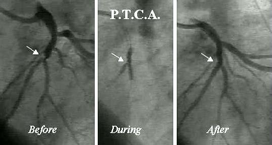 APPROACHES TO TREAT ANGINA PECTORIS To increase (or restore) coronary blood flow surgical and