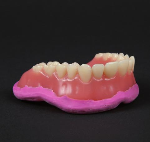 If the denture does not have a form-fit on the gingiva, it will be necessary to mold the patient's gingival situation using reline material.