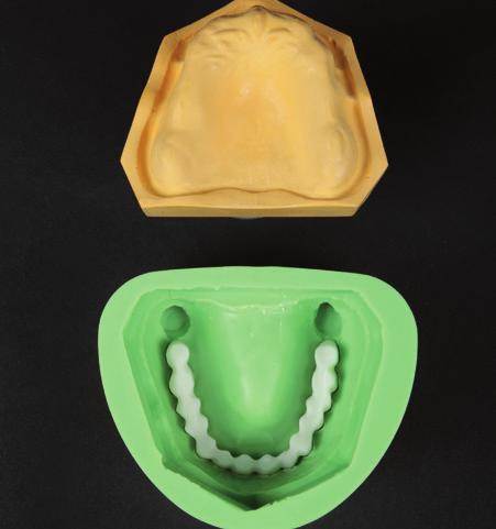 The acrylic mix must contact the surface of the model so that the dental arch acquires the shape of the mucosal situation. 2.4.7 Allow the dental arch made of radio-opaque acrylic to cure.