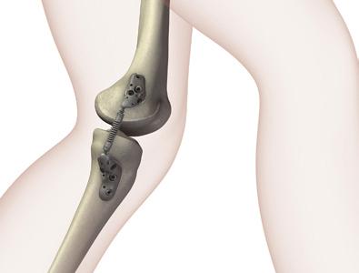 KineSpring Knee Implant